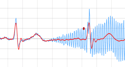 ecg digital filter ECG digital signal processing, ECG_reference_IPblocks baseline wandering noise reduction 50hz cancellation Savitzky-Golay Filter biomedical signal analysis, ECG signal procssing, ECG DSP