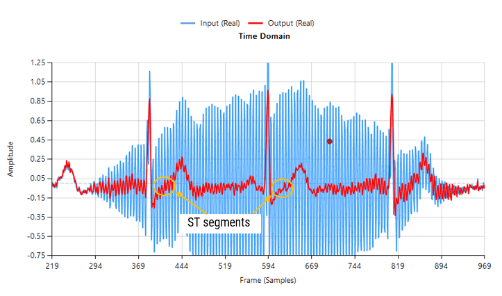 ECG contaminé par des interférences 50Hz non stationnaires (filtrage FIR), traitement des signaux ECG, DSP ECG, mesure ECG